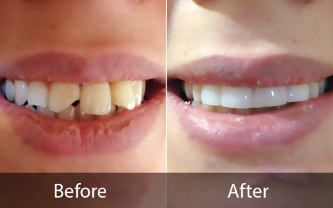 اصلاح شکستگی دندان ها