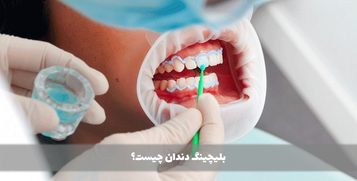 بلیچینگ دندان چیست؟