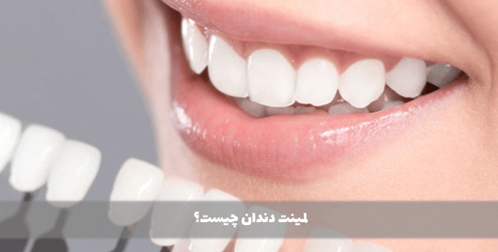 لمینت-دندان-چیست؟