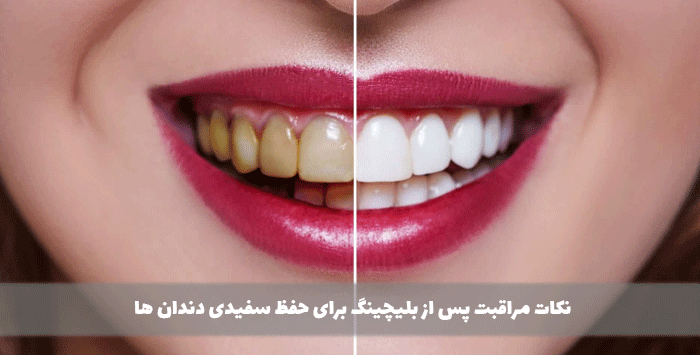 نکات مراقبت پس از بلیچینگ برای حفظ سفیدی دندان ها
