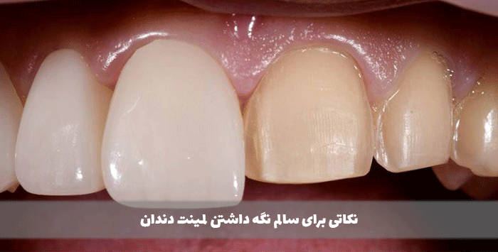 نکاتی-برای-سالم-نگه-داشتن-لمینت-دندان