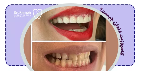 کامپوزیت دندان چیست؟