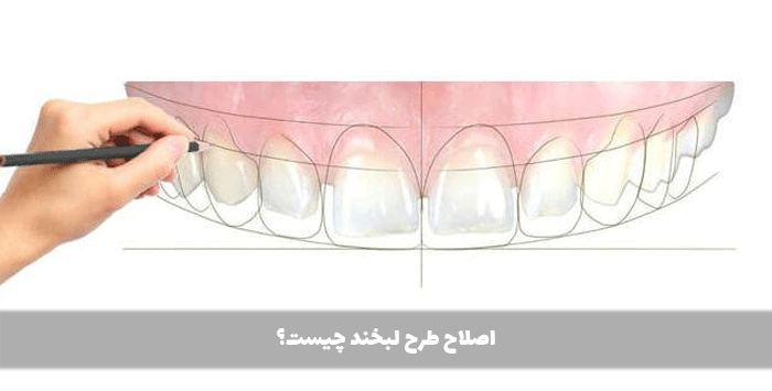 اصلاح طرح لبخند چیست؟