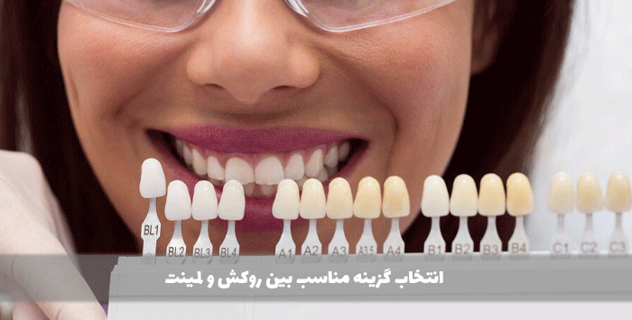 انتخاب گزینه مناسب بین روکش و لمینت