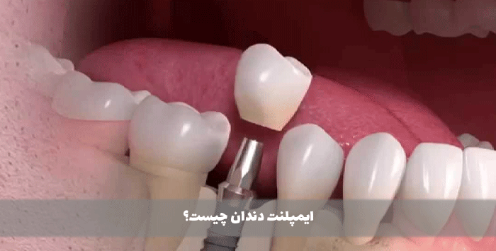 ایمپلنت دندان چیست؟