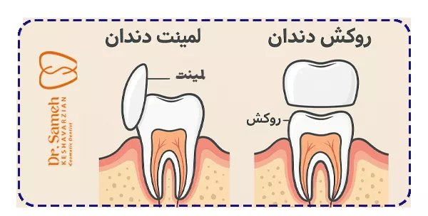 تفاوت های کلیدی روکش و لمینت دندان تفاوت های کلیدی روکش و لمینت دندان