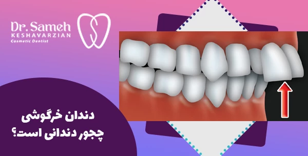 دندان خرگوشی چجور دندانی است؟