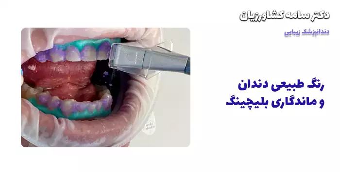  رنگ طبیعی دندان و ماندگاری بلیچینگ