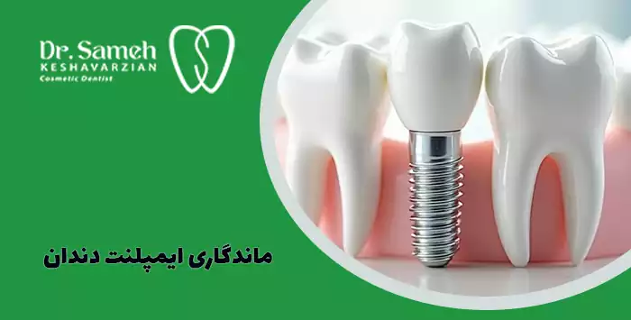 ماندگاری ایمپلنت دندان
