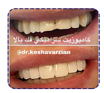 نمونه کار کامپوزیت سرامیکی دندان خرگوشی نمونه کار کامپوزیت سرامیکی دندان خرگوشی