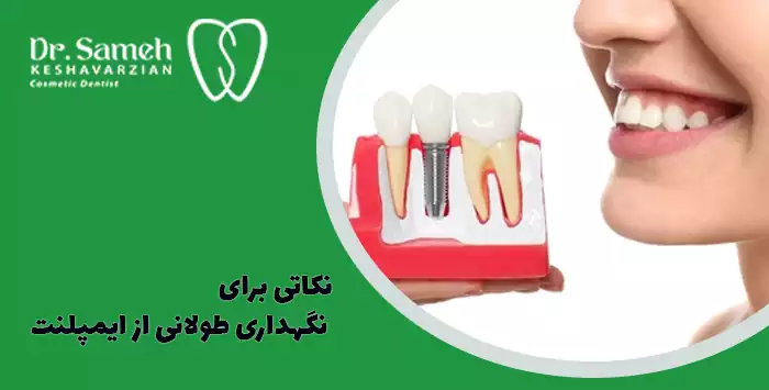 نکاتی برای نگهداری طولانی از ایمپلنت