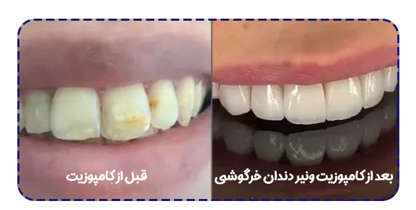 کامپوزیت دندان خرگوشی نمونه کار کامپوزیت دندان خرگوشی نمونه کار
