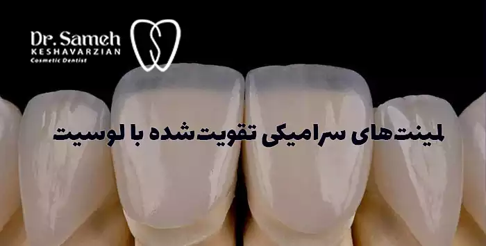 2. لمینت‌های سرامیکی تقویت‌شده با لوسیت