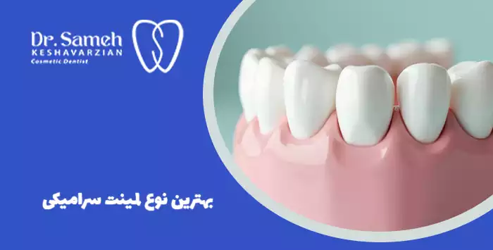 بهترین نوع لمینت سرامیکی