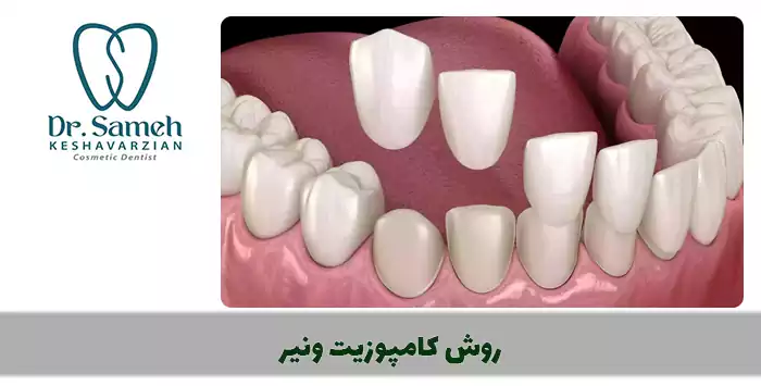 روش کامپوزیت ونیر