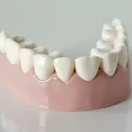 لمینت سرامیکی دندان