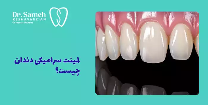 لمینت سرامیکی دندان چیست؟