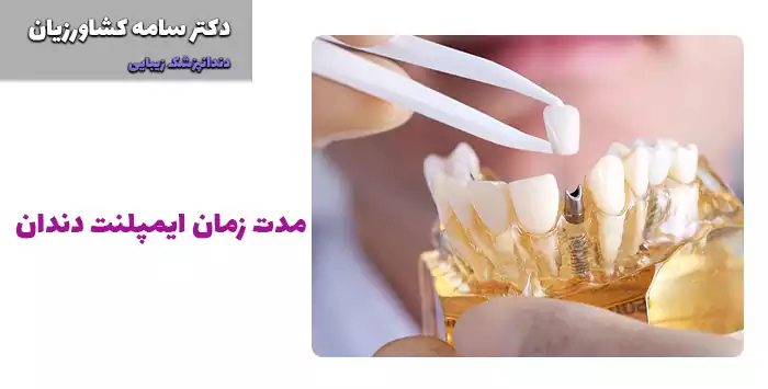 مدت زمان ایمپلنت دندان