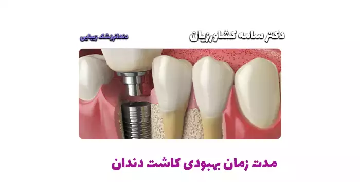  مدت زمان بهبودی کاشت دندان