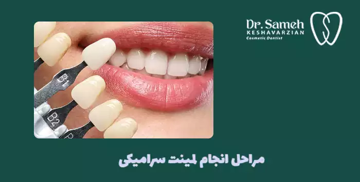مراحل انجام لمینت سرامیکی 
