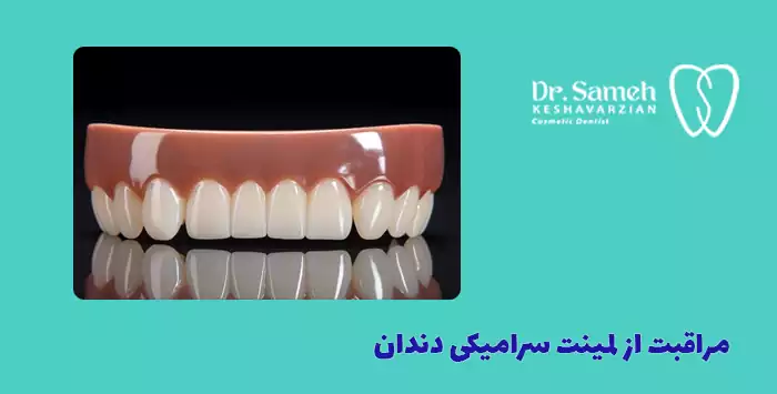 مراقبت از لمینت سرامیکی دندان