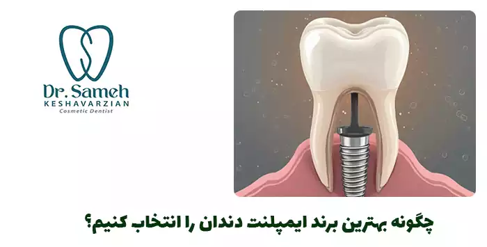 چگونه بهترین برند ایمپلنت دندان را انتخاب کنیم؟