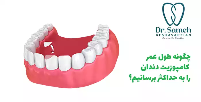 چگونه طول عمر کامپوزیت دندان را به حداکثر برسانیم؟