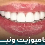 کامپوزیت ونیر