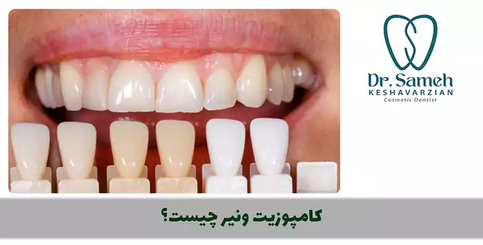  کامپوزیت ونیر چیست؟