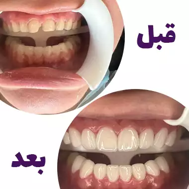 قبل و بعد لمینت دندان
