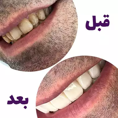 نمونه لمینت دندان