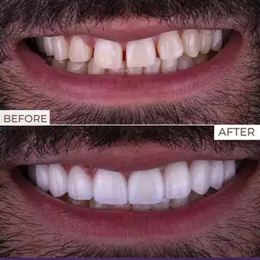 نمونه کامپوزیت دندان