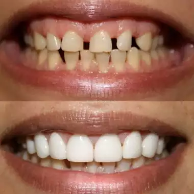 نمونه لمینت دندان