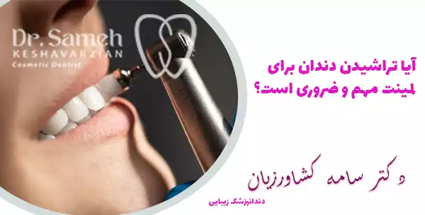 آیا تراشیدن دندان برای لمینت ضروری است؟