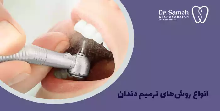 انواع روش‌های ترمیم دندان
