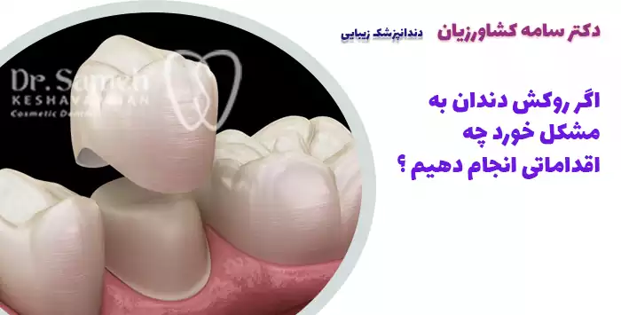 اگر روکش دندان به مشکل خورد چه اقداماتی انجام دهیم ؟