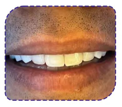 ترکیبی از ترمیم، درمان ریشه، روکش، ایمپلنت و لمینیت ترکیبی از ترمیم، درمان ریشه، روکش، ایمپلنت و لمینیت