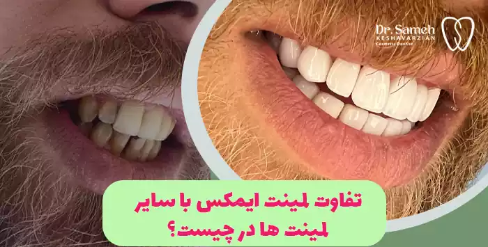 تفاوت لمینت ایمکس با سایر لمینت ها در چیست؟