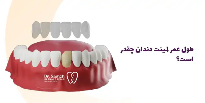 طول عمر لمینت دندان چقدر است؟