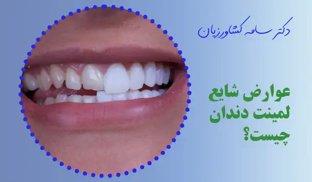 عوارض شایع لمینت دندان چیست؟