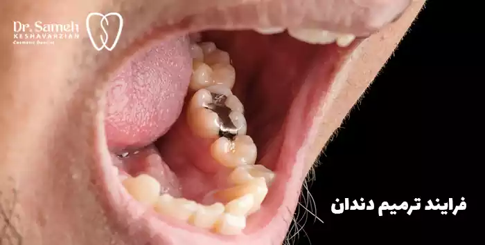 فرایند ترمیم دندان