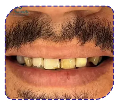 قبل از کار روی دندان قبل از ترکیبی از ترمیم، درمان ریشه، روکش، ایمپلنت و لمینیت