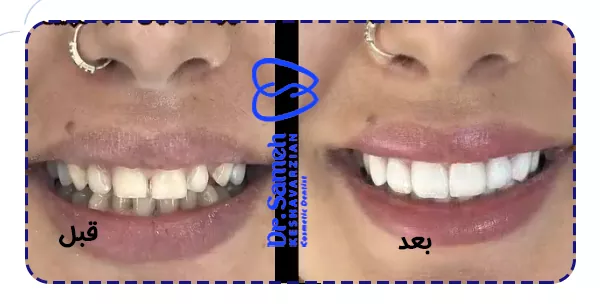 لمیت سرامیکی دندان نمونه کار