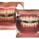 لمینت سرامیکی ایمکس