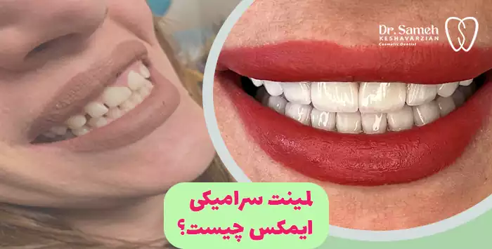 لمینت سرامیکی ایمکس چیست؟