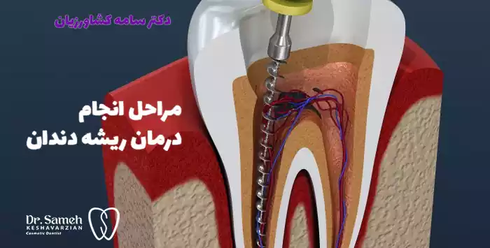 مراحل انجام درمان ریشه دندان