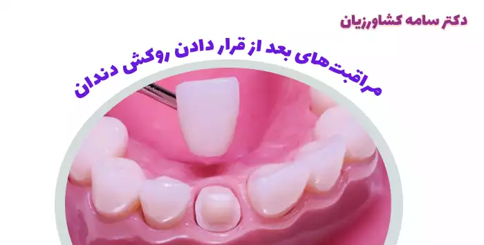 مراقبت‌های بعد از قرار دادن روکش دندان