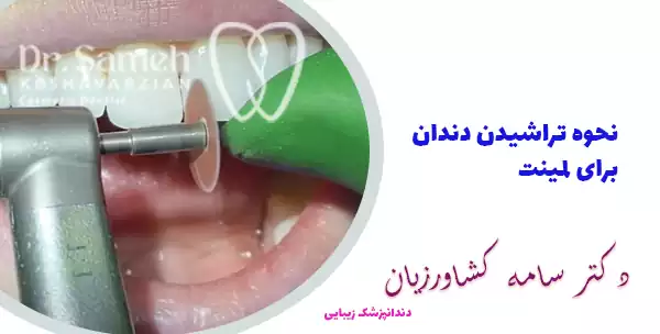 نحوه تراشیدن دندان برای لمینت