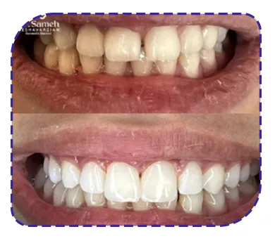 نمونه کار کامپوزیت لیرینگ نمونه کار کامپوزیت لیرینگ