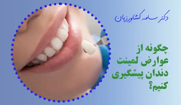 چگونه از عوارض لمینت دندان پیشگیری کنیم؟